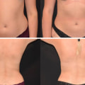 Liposuction Before and After Photos: What You Need to Know