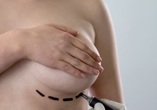 What is the divorce rate for plastic surgery?