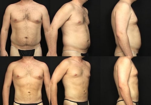 Different Techniques for Liposuction: A Comprehensive Overview