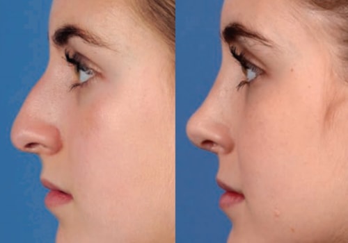 What is the difference between plastic surgery and normal surgery?